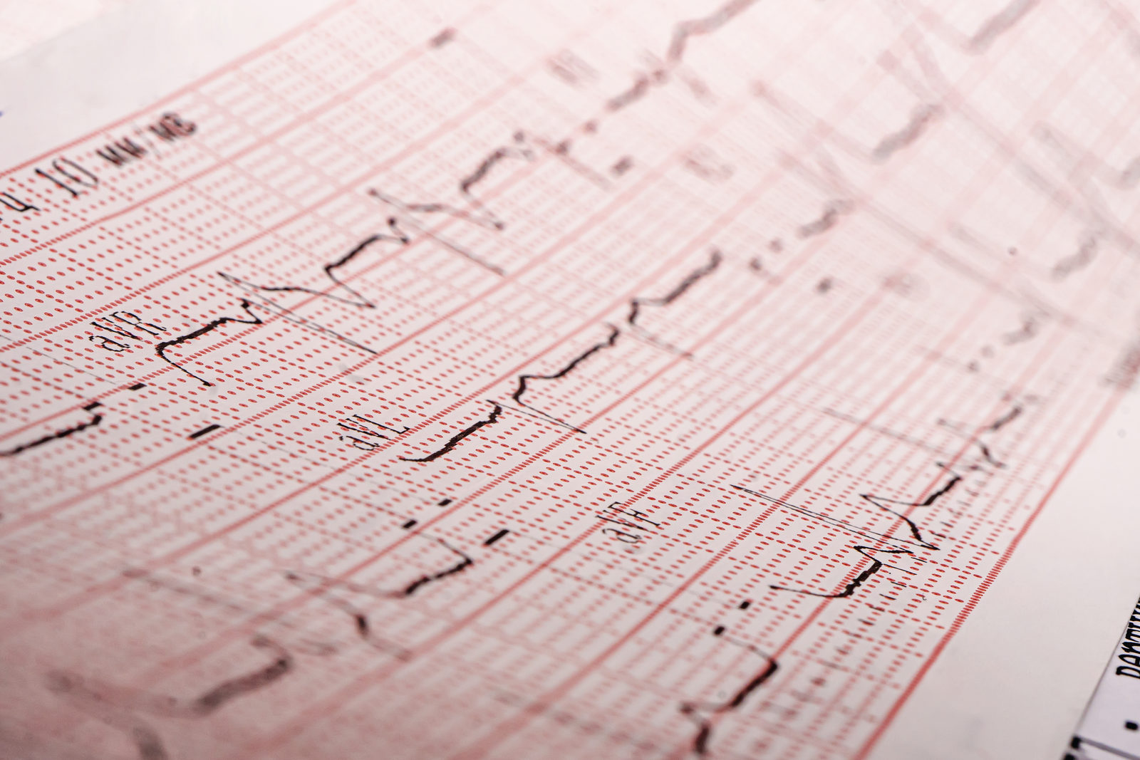 EKG-Ausdruck mit Herzstromkurve