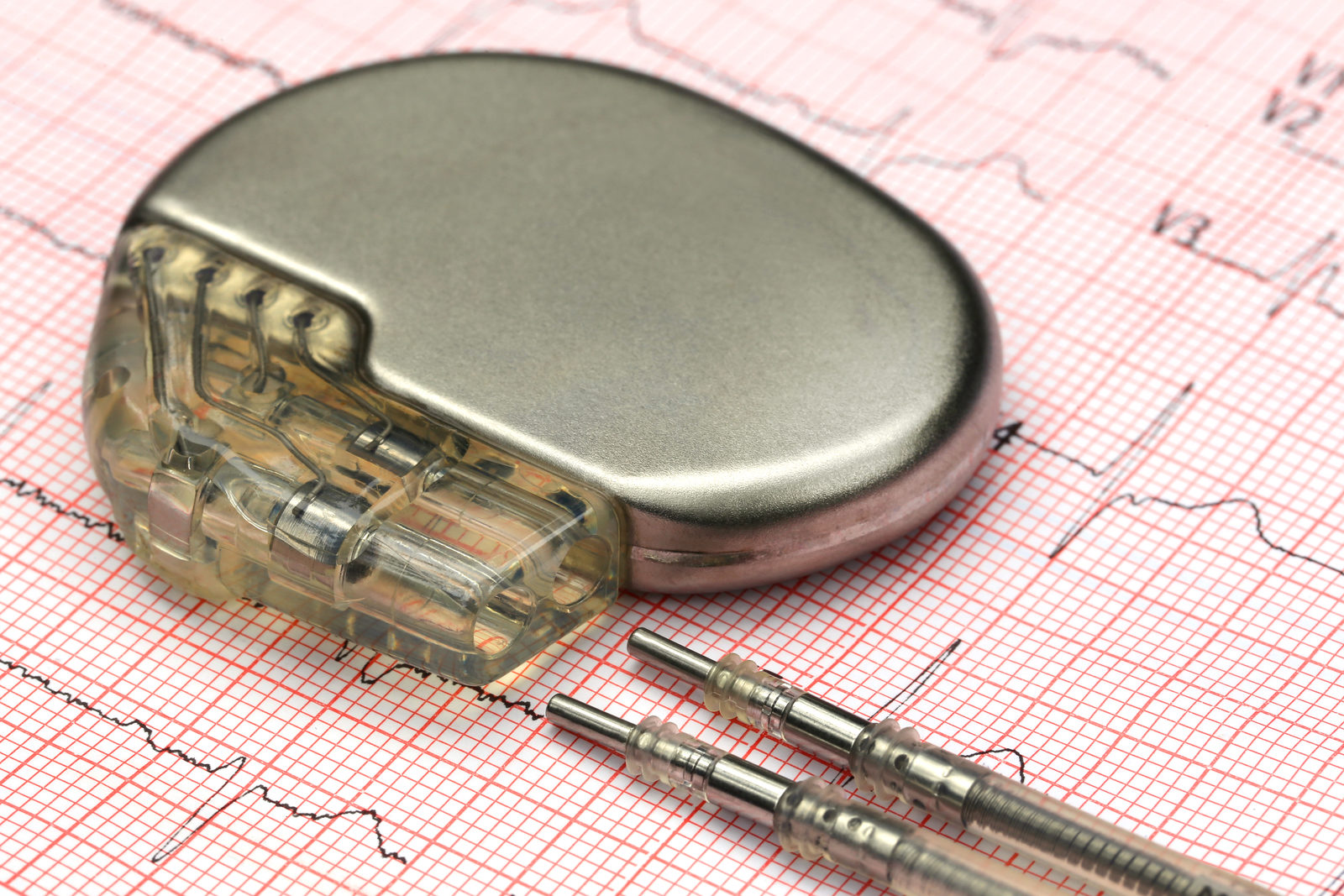 Herzschrittmacher auf einem EKG-Ausdruck